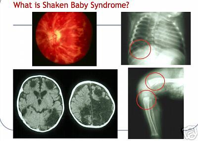   Pediatric Infant SHAKEN BABY SYNDROME PowerPoint Presentation on CD